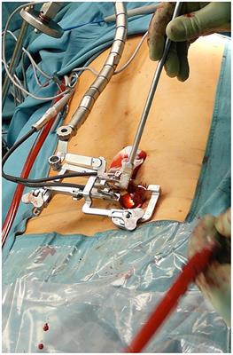 Accidental Dural Tears in Minimally Invasive Spinal Surgery for Degenerative Lumbar Spine Disease